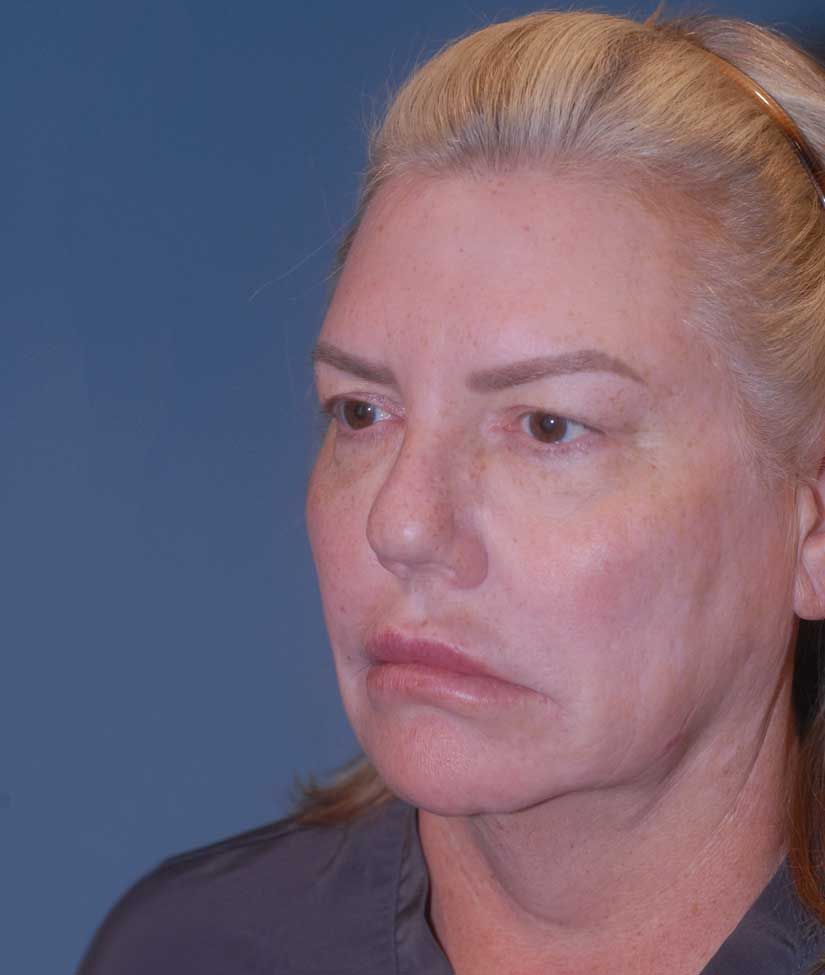 Facelift Before & After