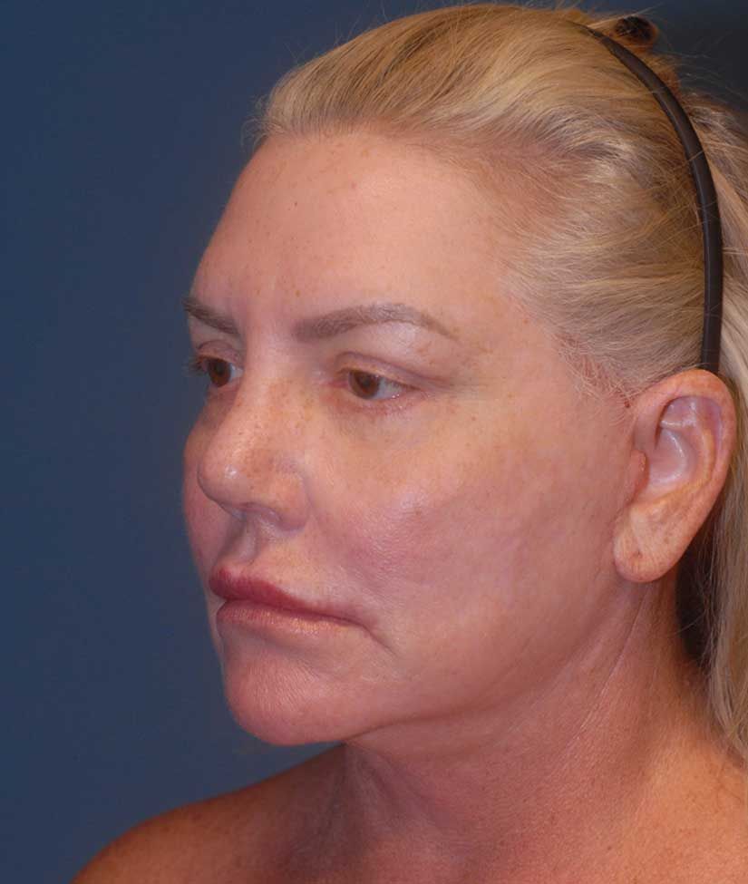 Facelift Before & After