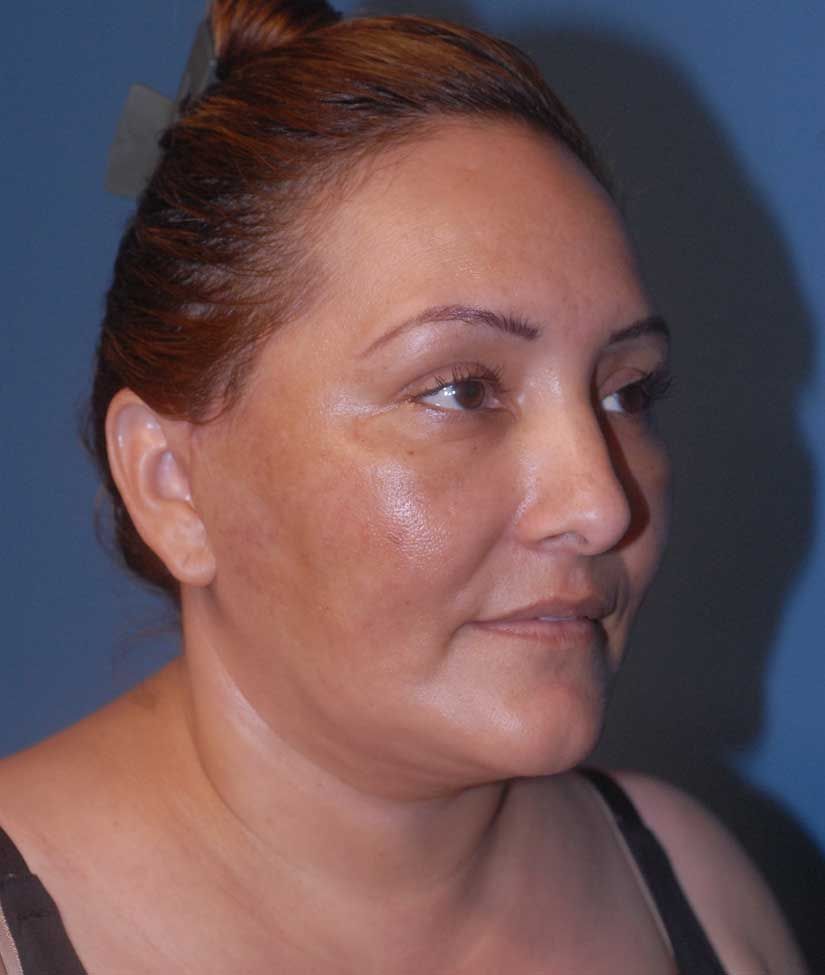 Facelift Before & After