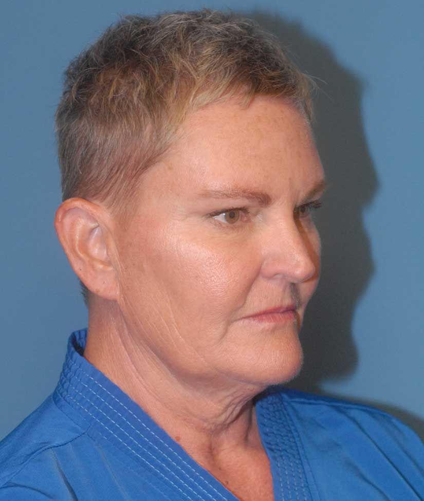 Facelift Before & After