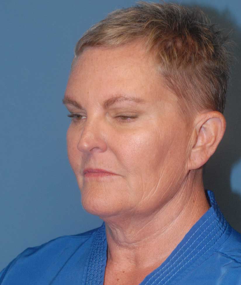 Facelift Before & After