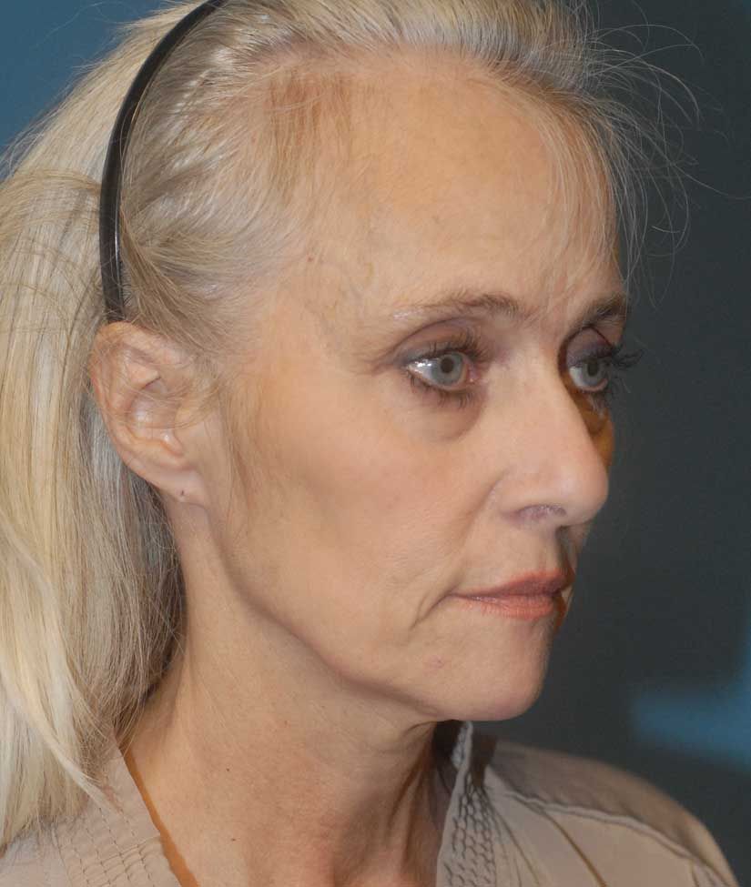 Facelift Before & After