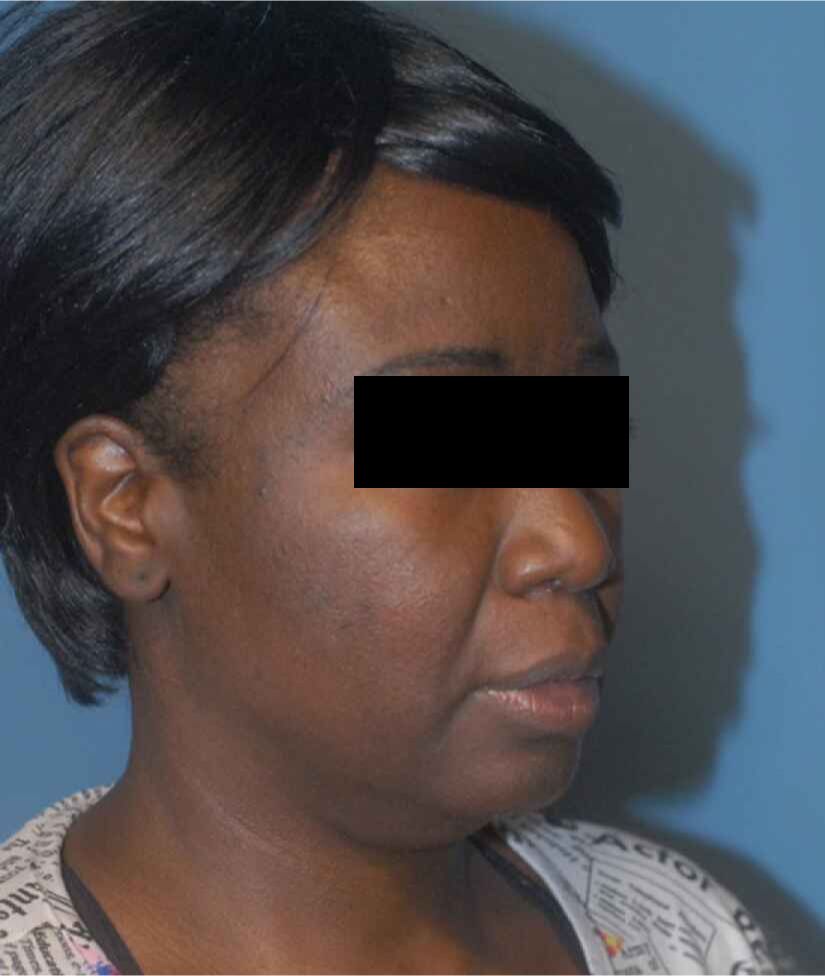 Facelift Before & After