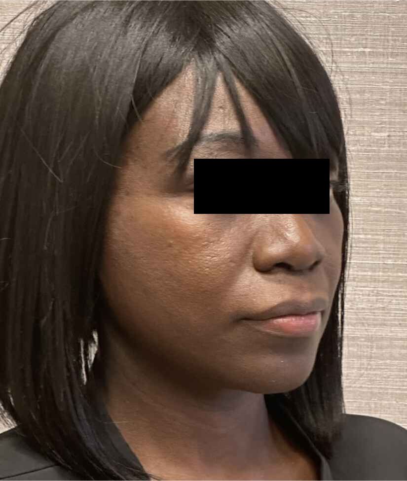 Facelift Before & After