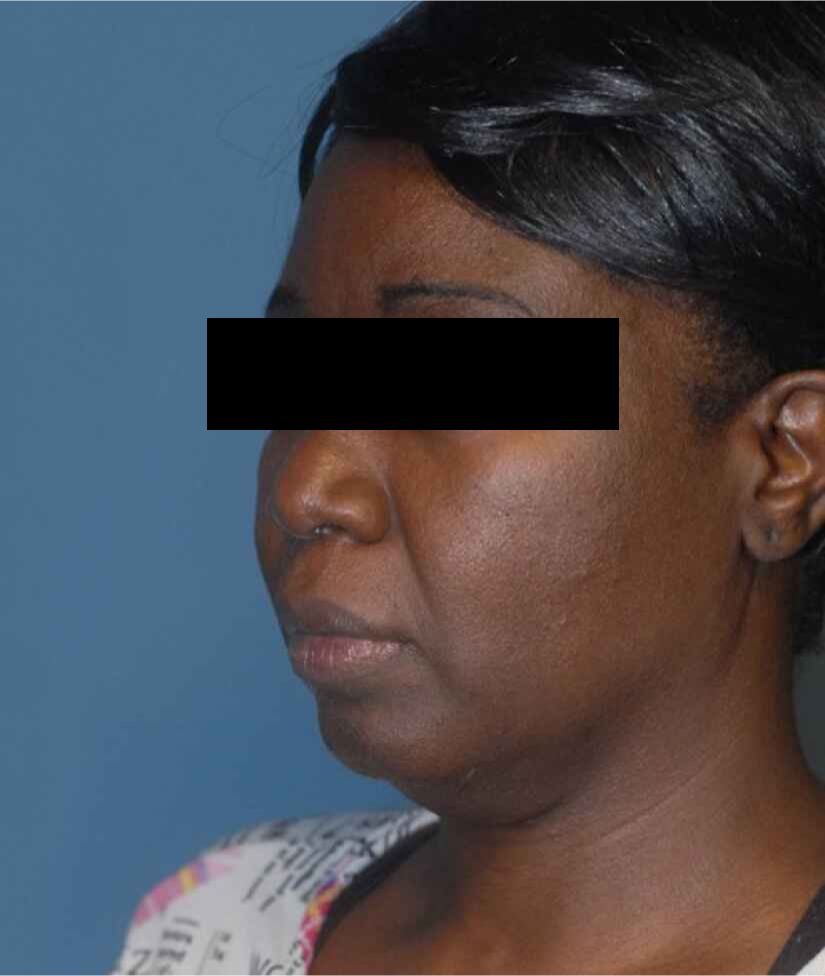 Facelift Before & After