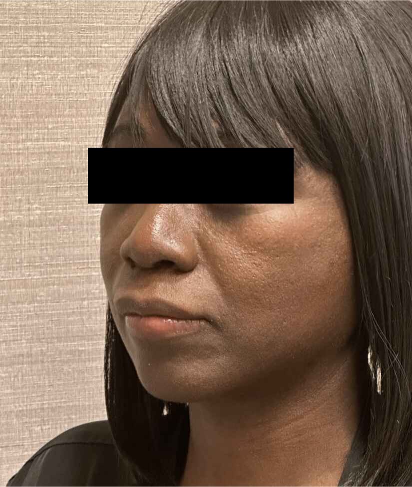 Facelift Before & After