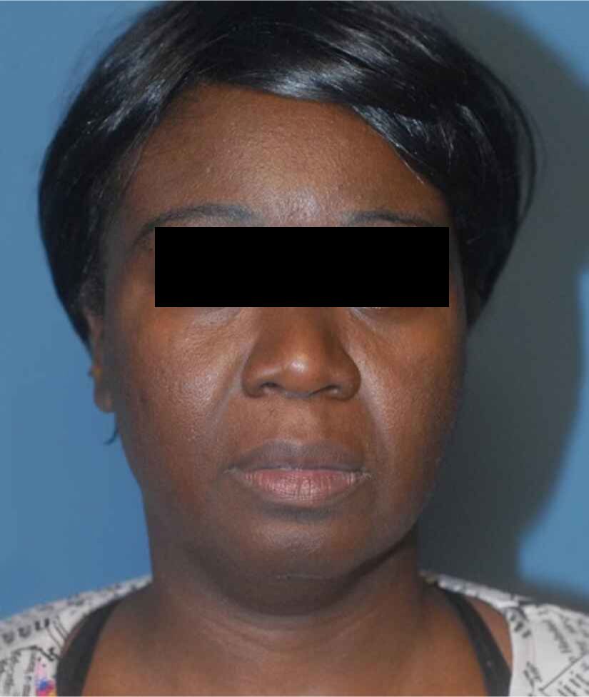 Facelift Before & After