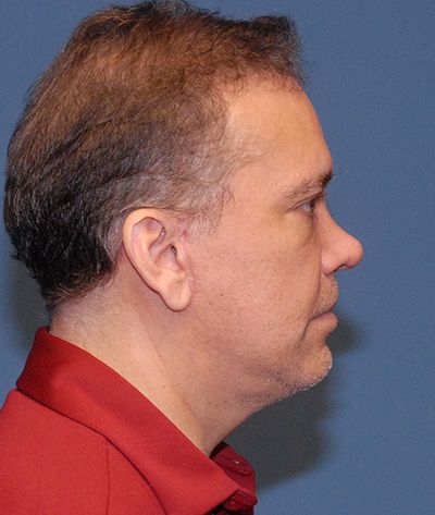 Facelift Before & After