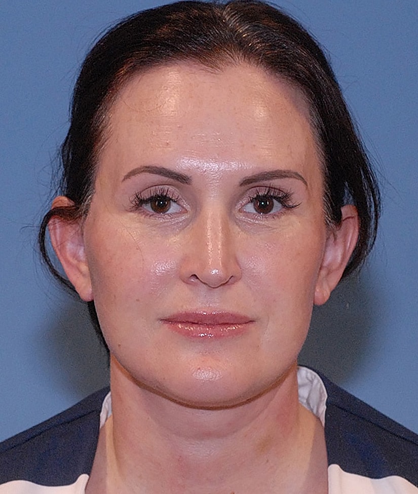 Facelift Before & After