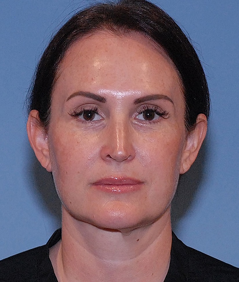 Facelift Before & After