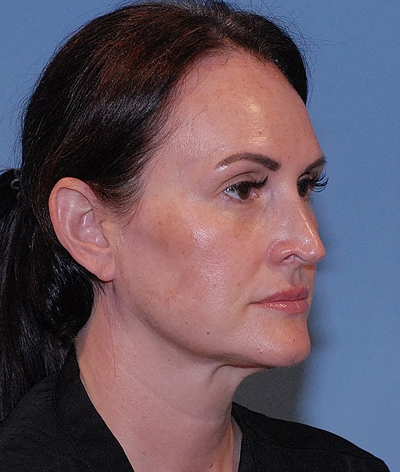 Facelift Before & After