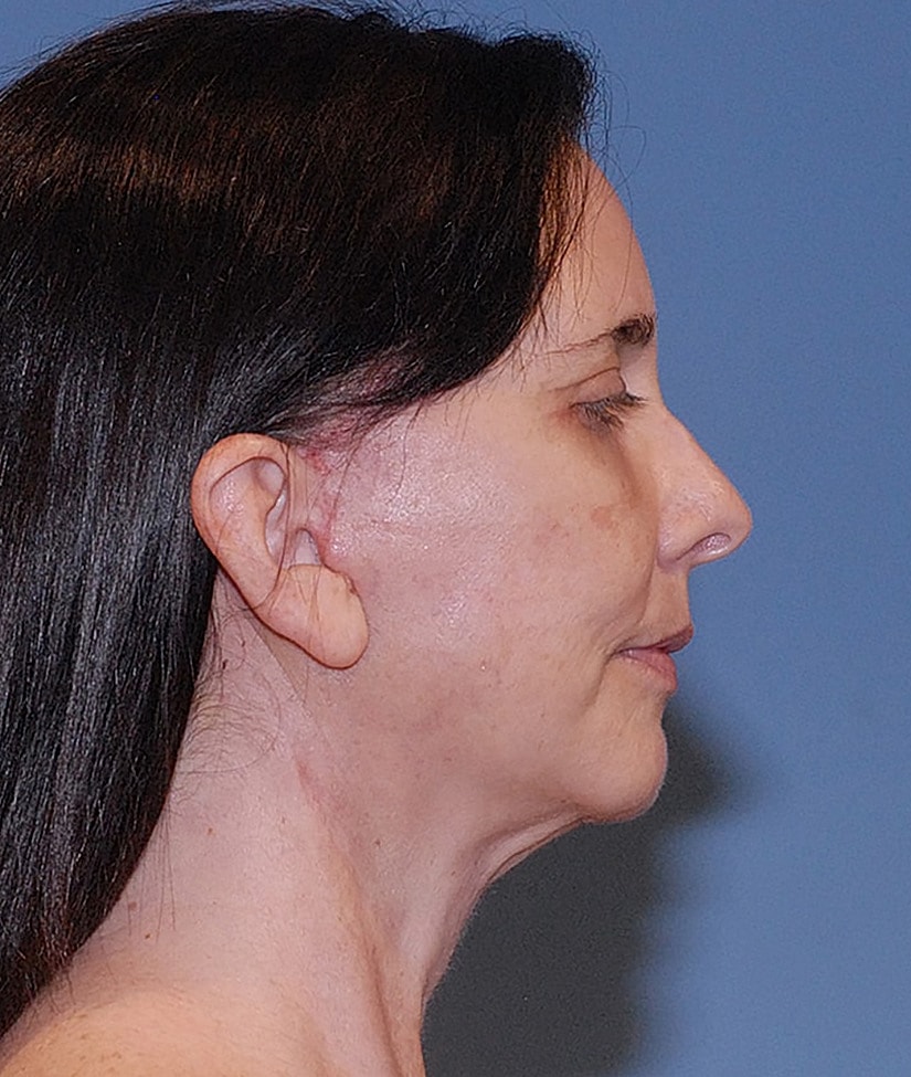 Facelift Before & After