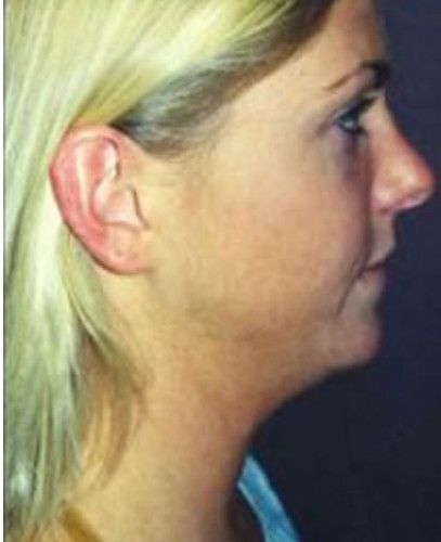 Rhinoplasty Before & After