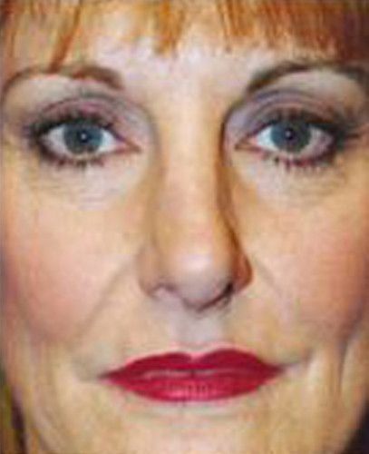 Rhinoplasty Before & After