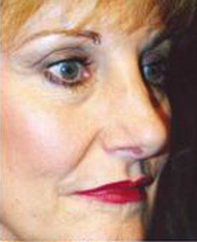 Rhinoplasty Before & After