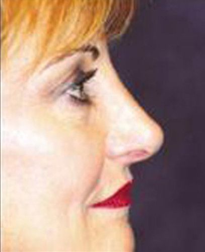 Rhinoplasty Before & After