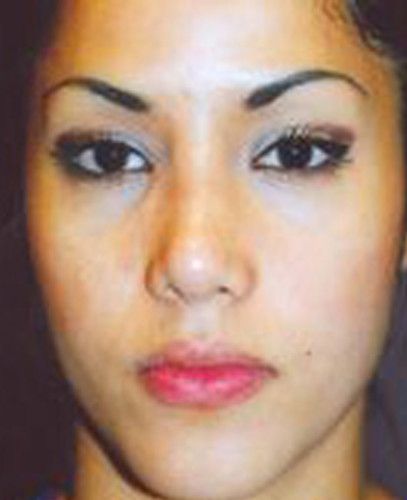 Rhinoplasty Before & After