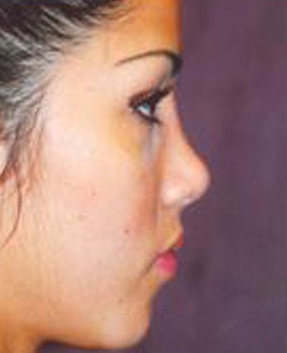 Rhinoplasty Before & After