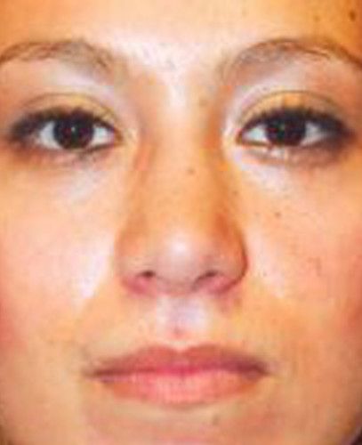 Rhinoplasty Before & After