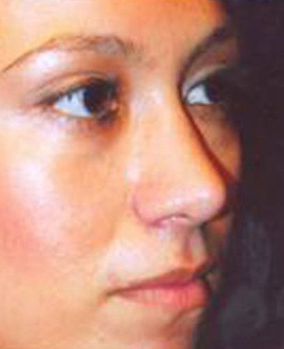 Rhinoplasty Before & After