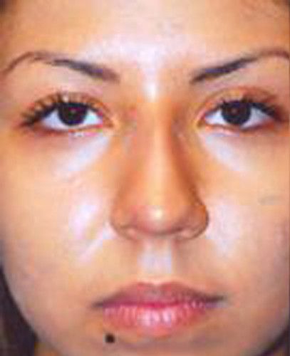 Rhinoplasty Before & After