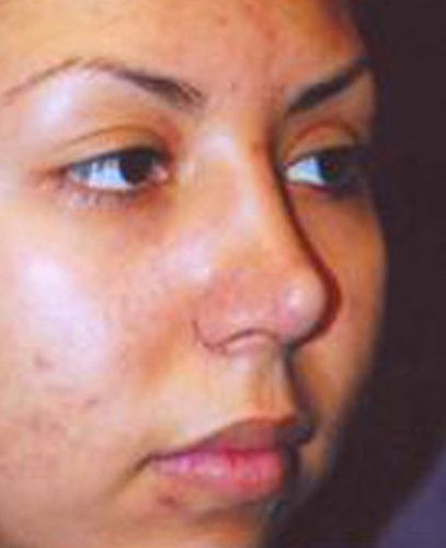 Rhinoplasty Before & After