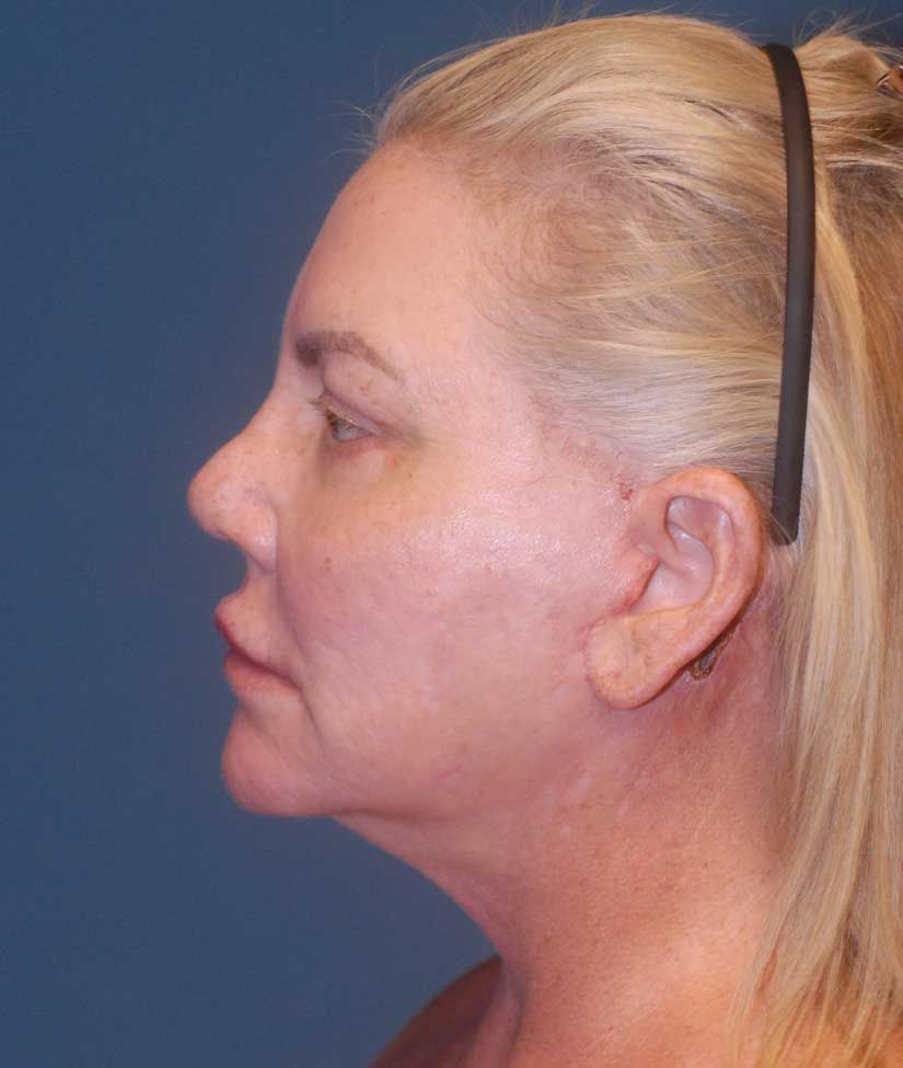 Rhinoplasty Before & After