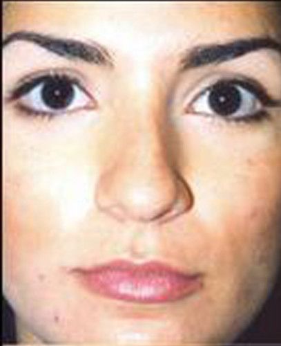 Rhinoplasty Before & After