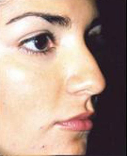 Rhinoplasty Before & After