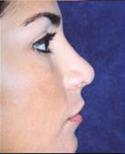 Rhinoplasty Before & After