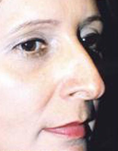 Rhinoplasty Before & After