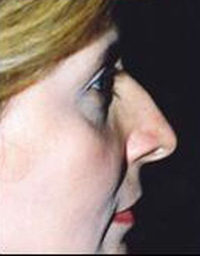 Rhinoplasty Before & After
