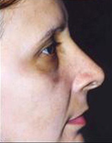 Rhinoplasty Before & After