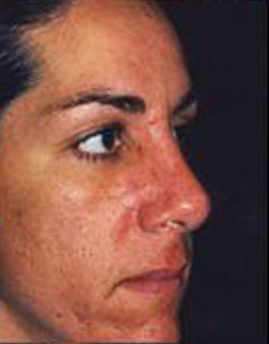Rhinoplasty Before & After