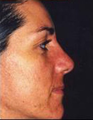Rhinoplasty Before & After