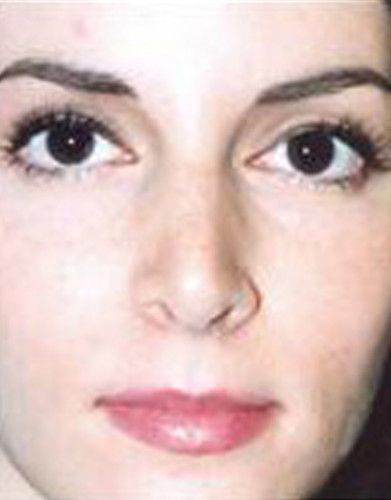 Rhinoplasty Before & After