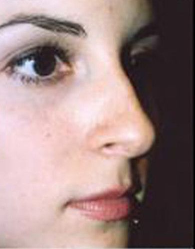 Rhinoplasty Before & After