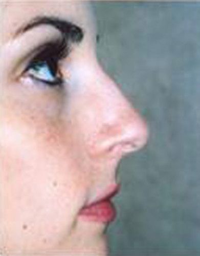 Rhinoplasty Before & After