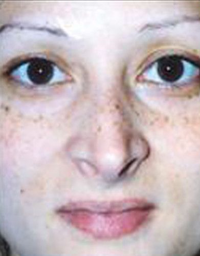 Rhinoplasty Before & After