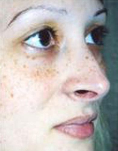 Rhinoplasty Before & After