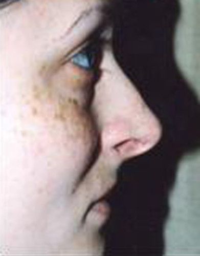 Rhinoplasty Before & After