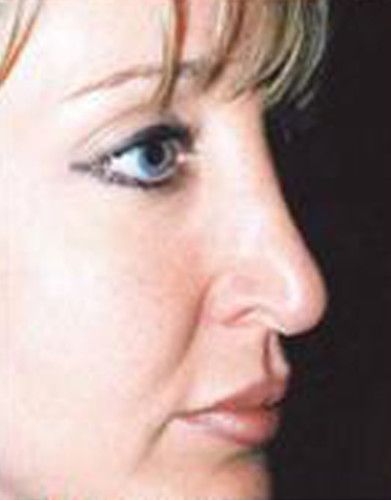 Rhinoplasty Before & After