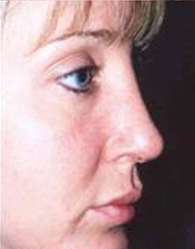 Rhinoplasty Before & After