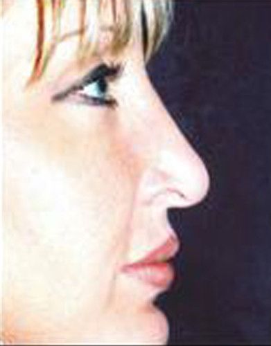 Rhinoplasty Before & After