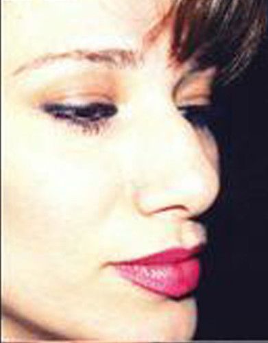 Rhinoplasty Before & After