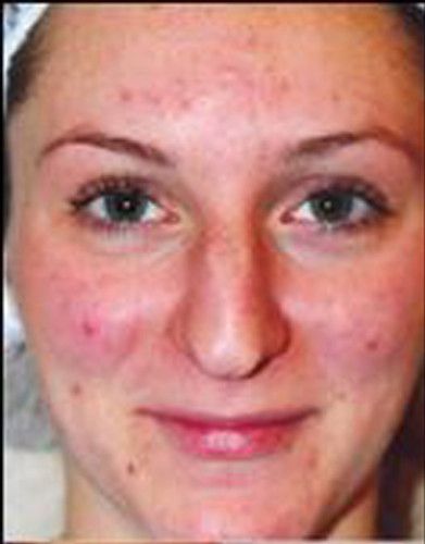 Rhinoplasty Before & After