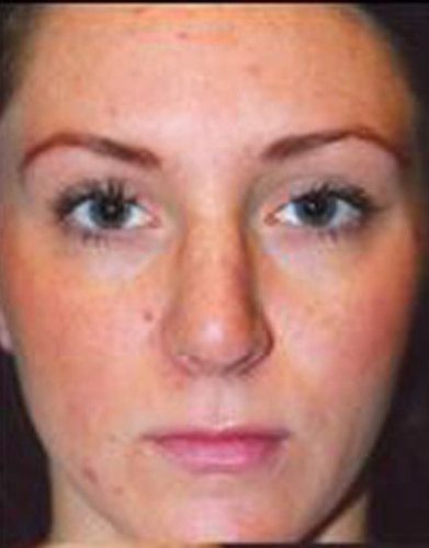 Rhinoplasty Before & After