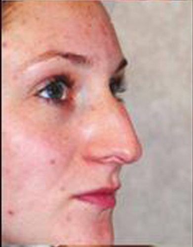Rhinoplasty Before & After