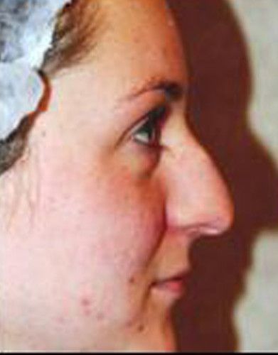 Rhinoplasty Before & After