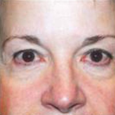 Rhinoplasty Before & After